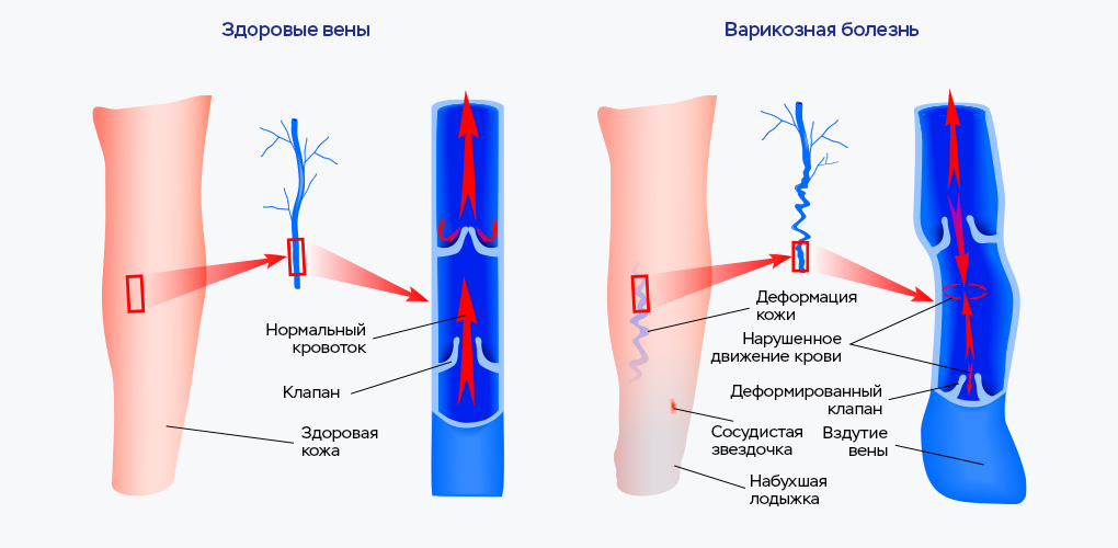 Варикоз Вен На Ногах Какой Лечит Врач