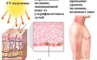 Как выглядит ожоги от солнца фото