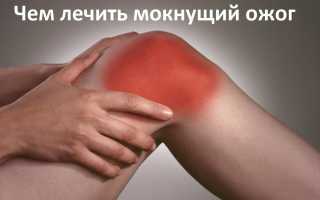 Как лечат открытые раны от ожога