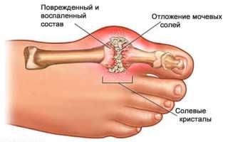 Препарат бад для лечения подагры