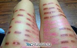 Как заживают ожоги после лазера