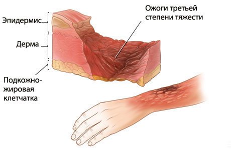 Обугливание кожи при ожоге относится к