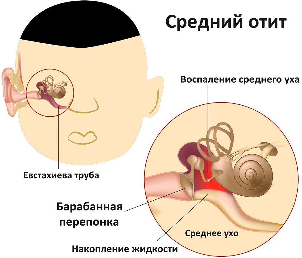 Лечение аденоидов и отита у детей