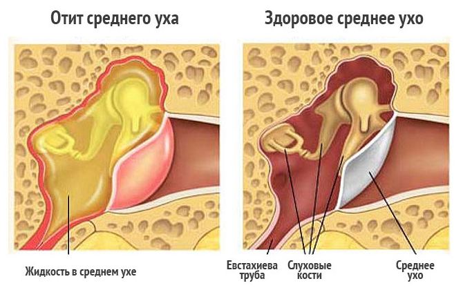 Так проявляется отит