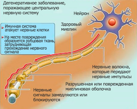 Немеет лицо при отите у