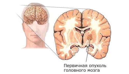 Немеет лицо при отите у