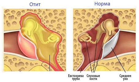Повторный отит на другое ухо