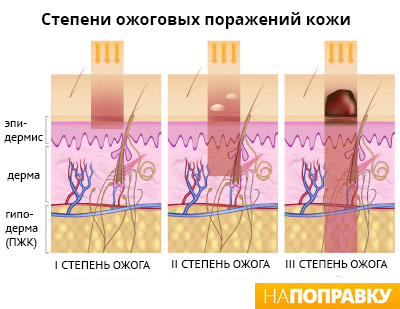 степени ожоговых поражений кожи.jpg
