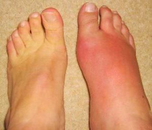 Как принимать Найз при подагре