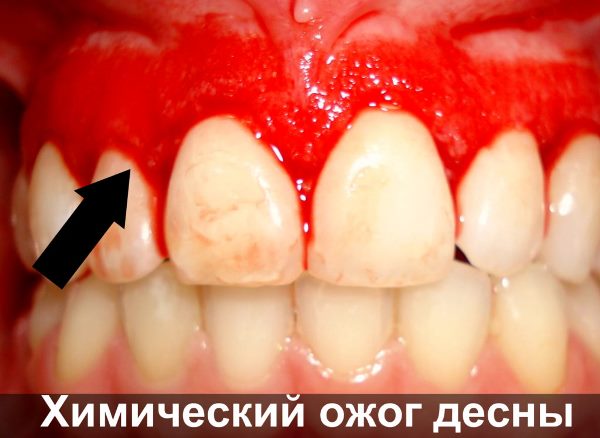 Химический ожог десен фото