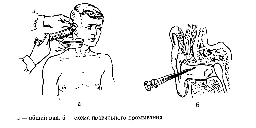 Что делать, если заложило ухо: промывание уха