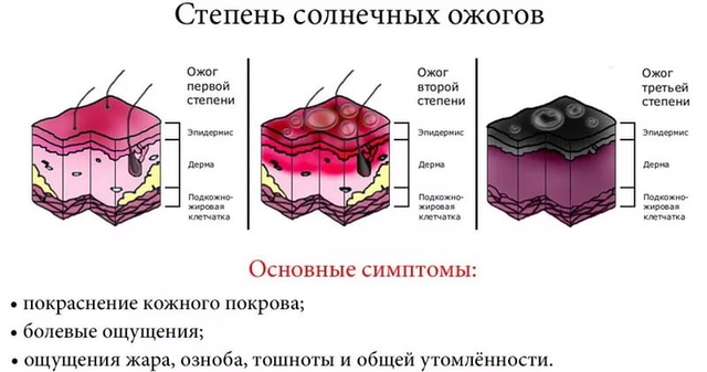 chto-delat-pri-solnechnom-ozhoge