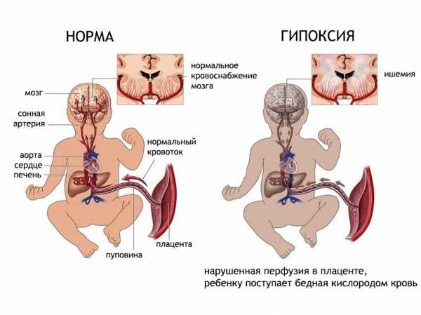 Гипоксия плода