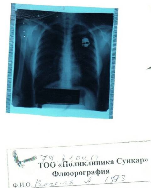 Флюорография
