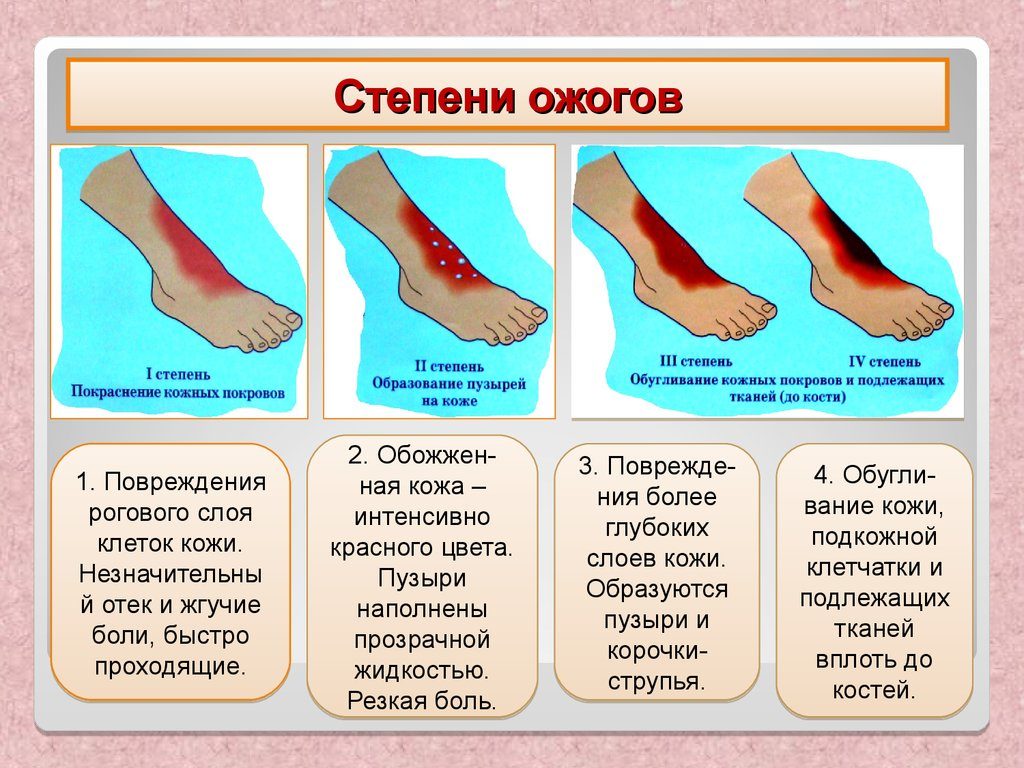 Как избежать ожога марганцовкой