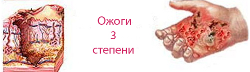 Ожог кожи 3 степени что это thumbnail
