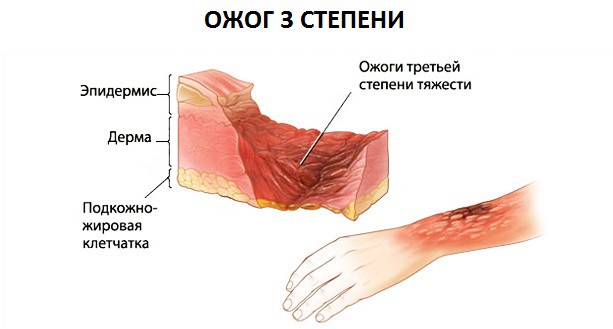 ожог 3 степени