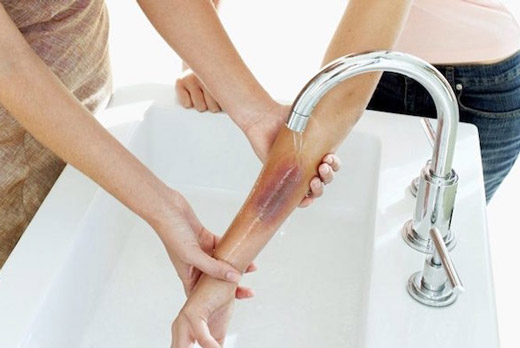 Первая помощь при ожоге