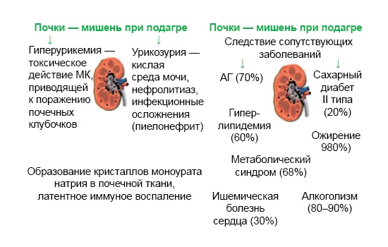 Поражение почек при подагре