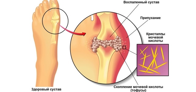 Изменения при подагре