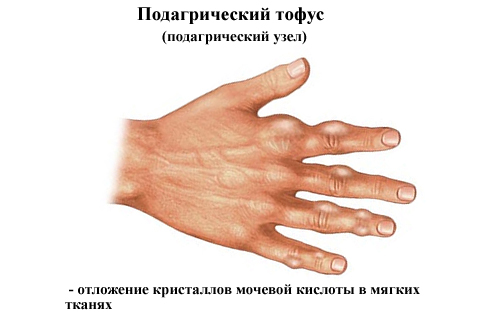 Подагрические тофусы