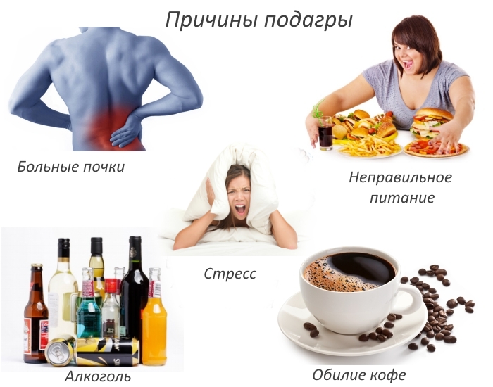 Частые причины подагры