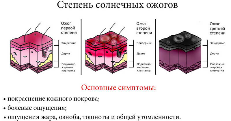simptomy-solnechnyh-ozhogov