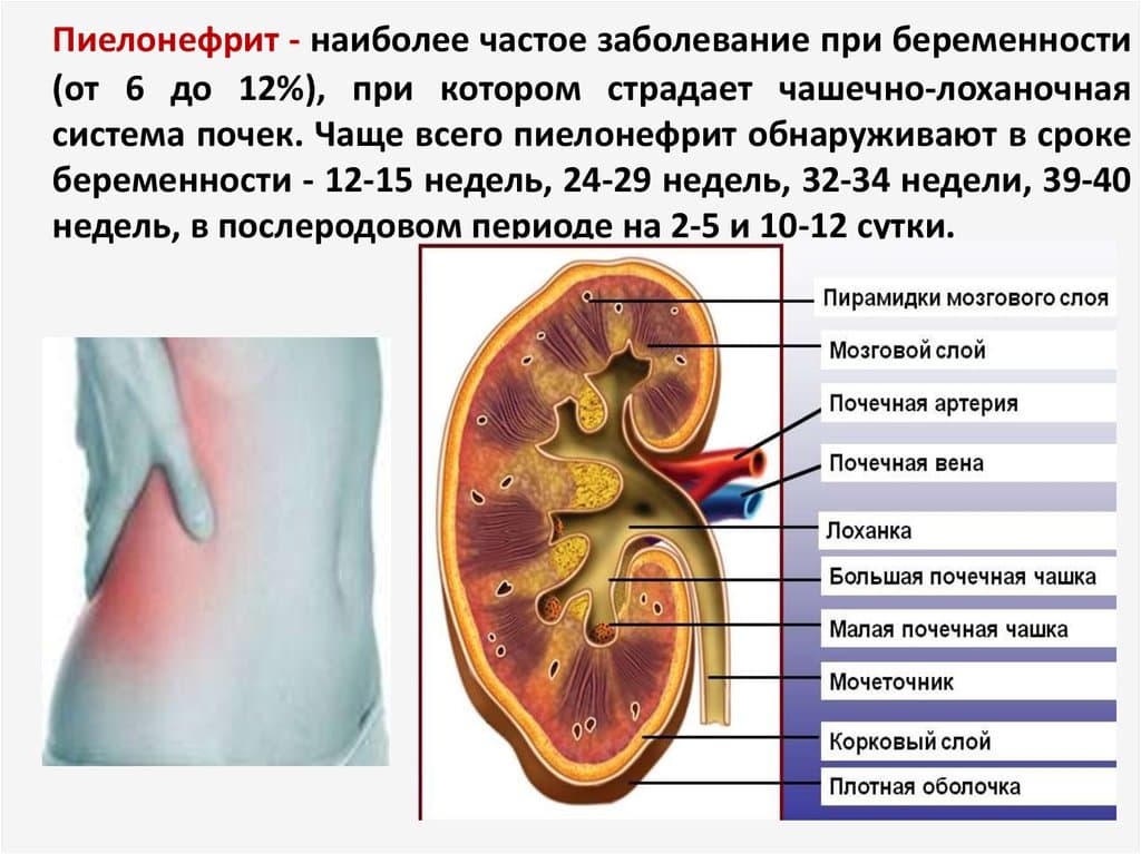 Пиелонефрит у беременных