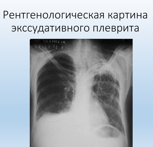 Плеврит