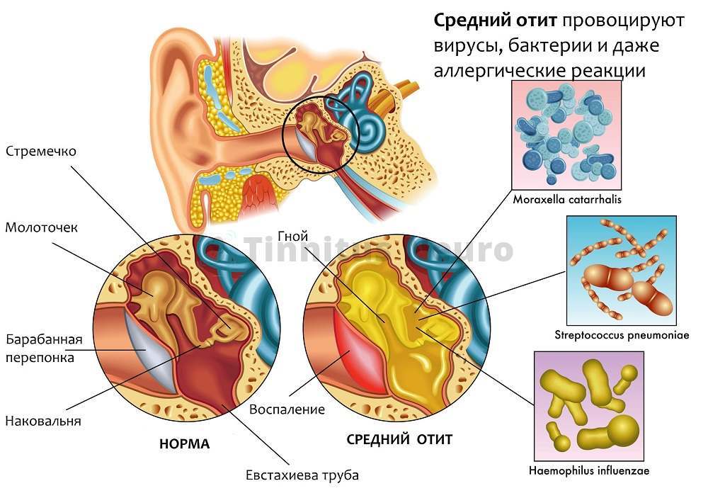 Шум в ушах чаще всего вызывает средний отит - наиболее распространенная форма болезни