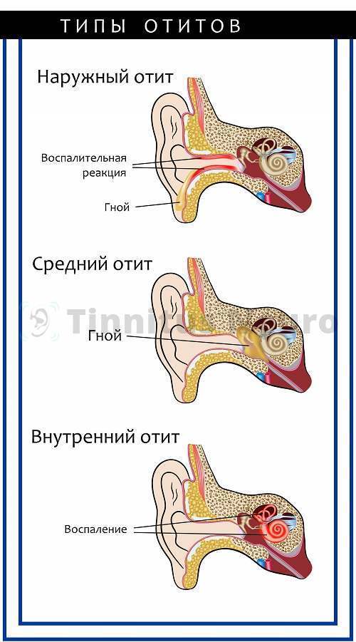 Разные виды отита отличаются локализацией воспаления и выраженностью гнойных процессов