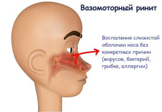 схема заболевания ринита