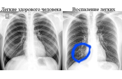 Обследование легких