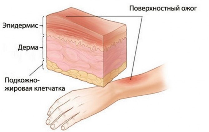 Глубина поражения тканей при ожогах