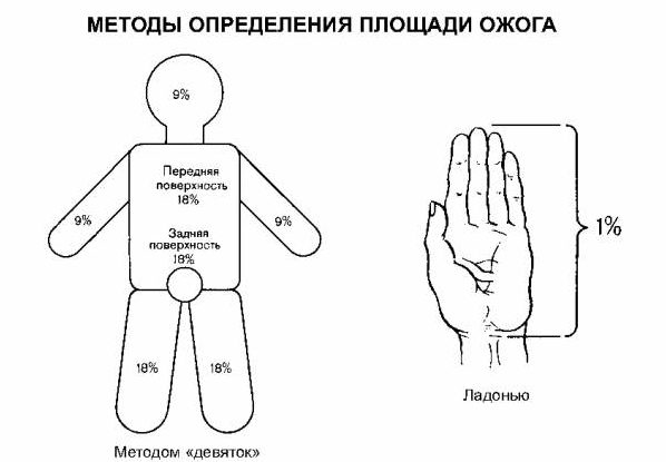 Площадь ожога по схеме