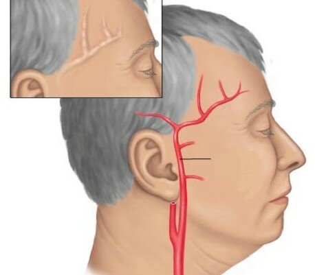 Болит голова в области левого виска и давит на глаза