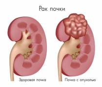Рак почки 209x180-equal_images_articles_rak-pochki