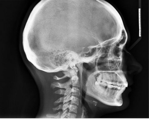 От чего болит голова при вставании