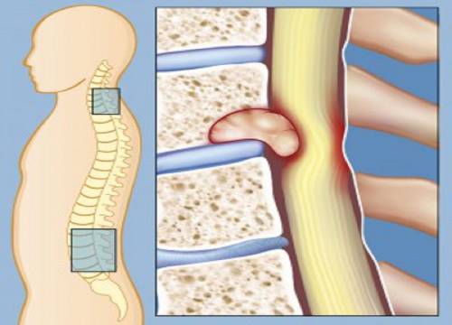 Метастазы в позвоночнике Метастазы в позвоночнике