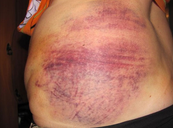 Ударился спиной болит почка