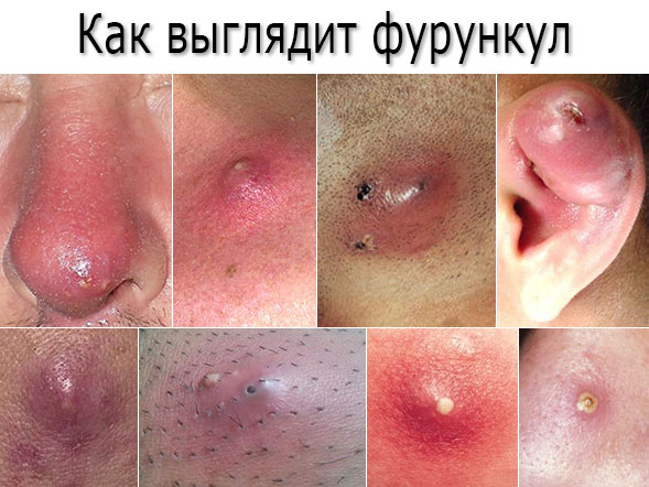 Как выглядит фурункул