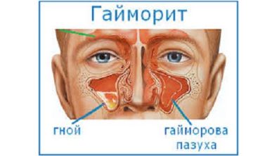 если болит спина и повышена температура