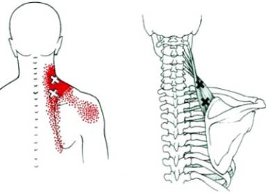 Болит спина чуть ниже лопаток