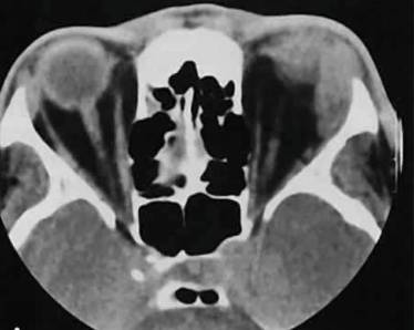 если болит спина и повышена температура