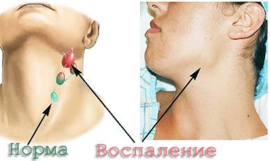 если болит спина и повышена температура