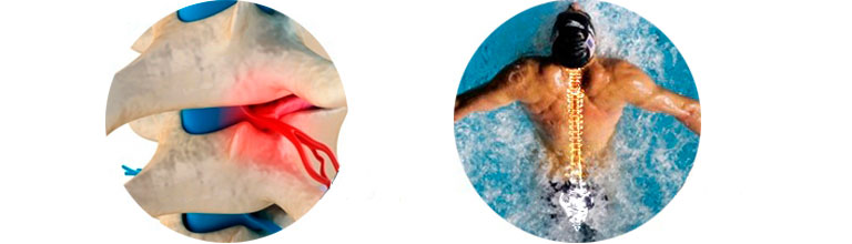 можно ли ходить в бассейн если болит спина