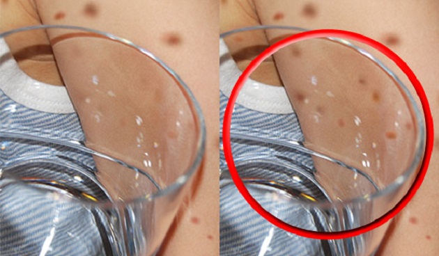 Симптомы менингита Симптомы менингита