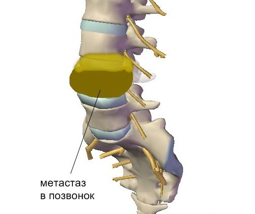 Метастаз в позвоночнике Метастаз в позвоночнике