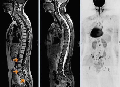 При метастазах в кости болит спина