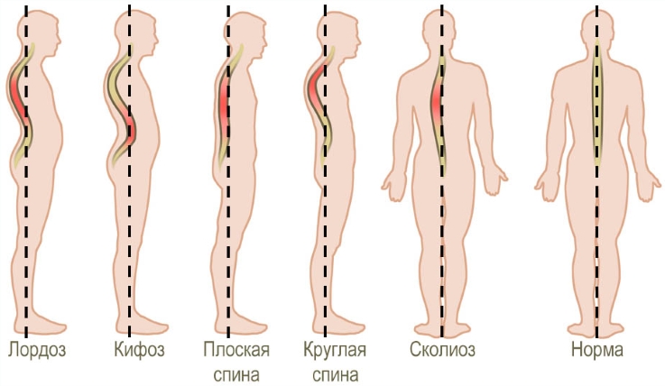 Искривления спины Искривления спины